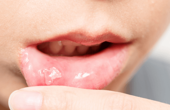 Close-up image of a painful mouth ulcer on the inner lower lip, commonly known as a canker sore.